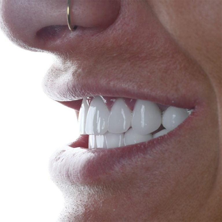 hollywoodsmile1-1686670927