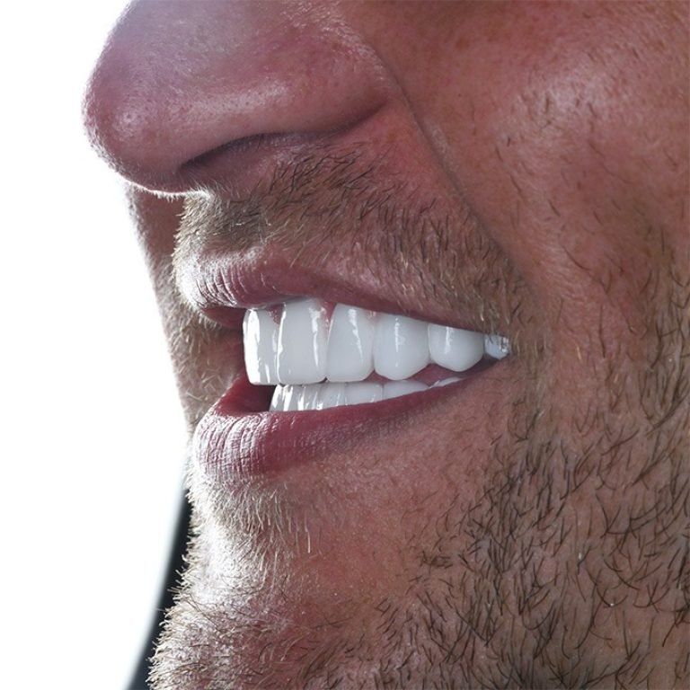 hollywoodsmile2-1686670928