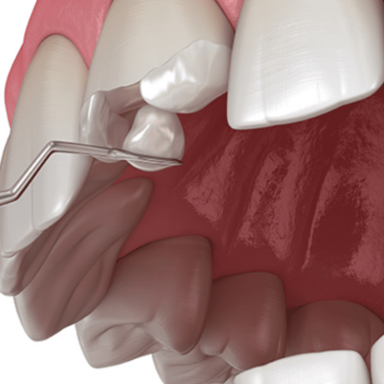 perla-dental-composite-laminate-1722855203