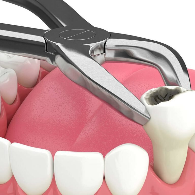 tooth-extraction-dental-service-1024x768
